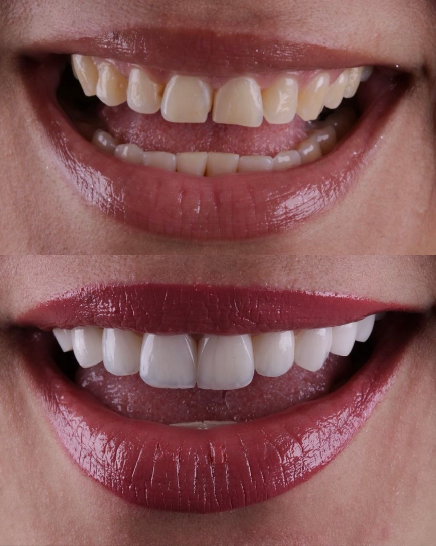 Resultado de Tratamento Odontológico - Antes e Depois